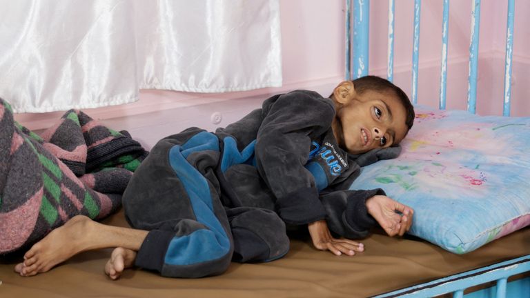 Anak laki-laki Palestina Osama Al-Reqep, 5, terbaring di tempat tidur di Rumah Sakit Nasser, di Khan Younis, di Jalur Gaza selatan. Foto: Reuters